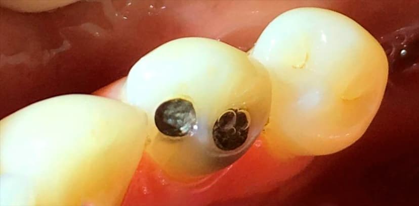 Cambio de Amalgama - Before