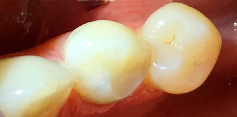 Cambio de Amalgama - After