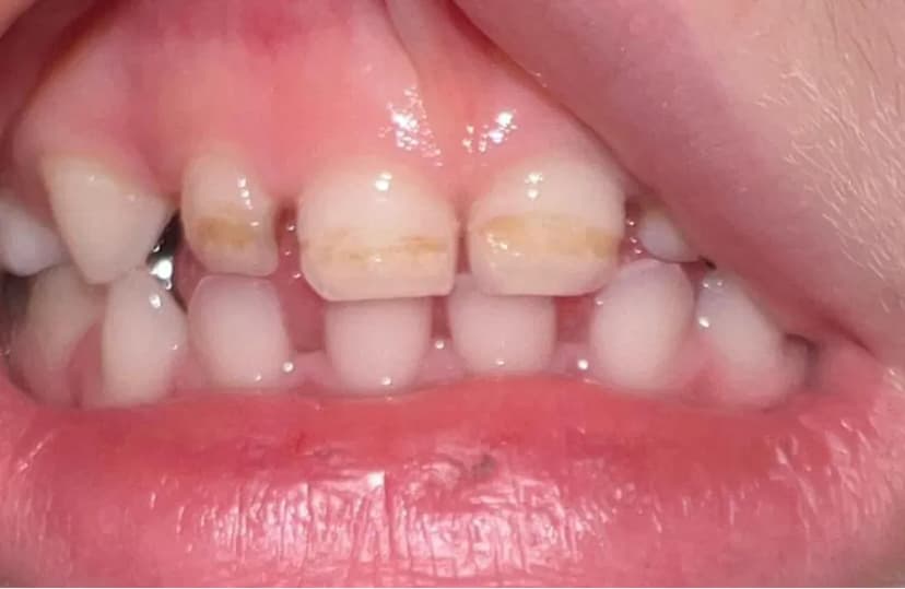 Caries de Biberón - Before