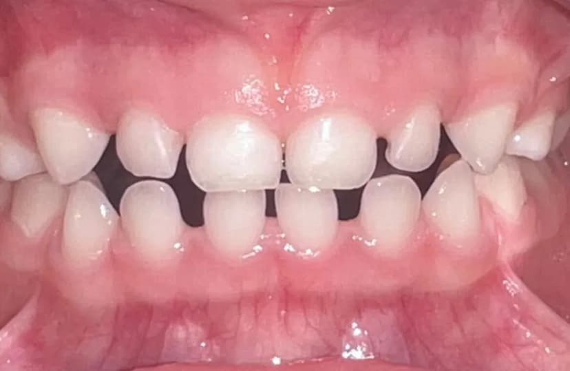 Caries de Biberón - After