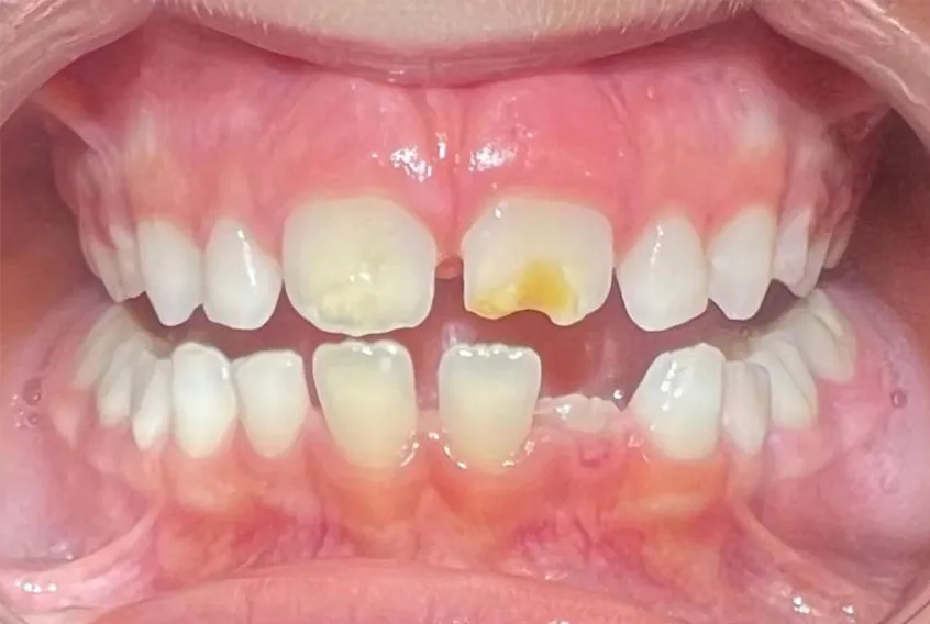 Defecto Congénito - Before