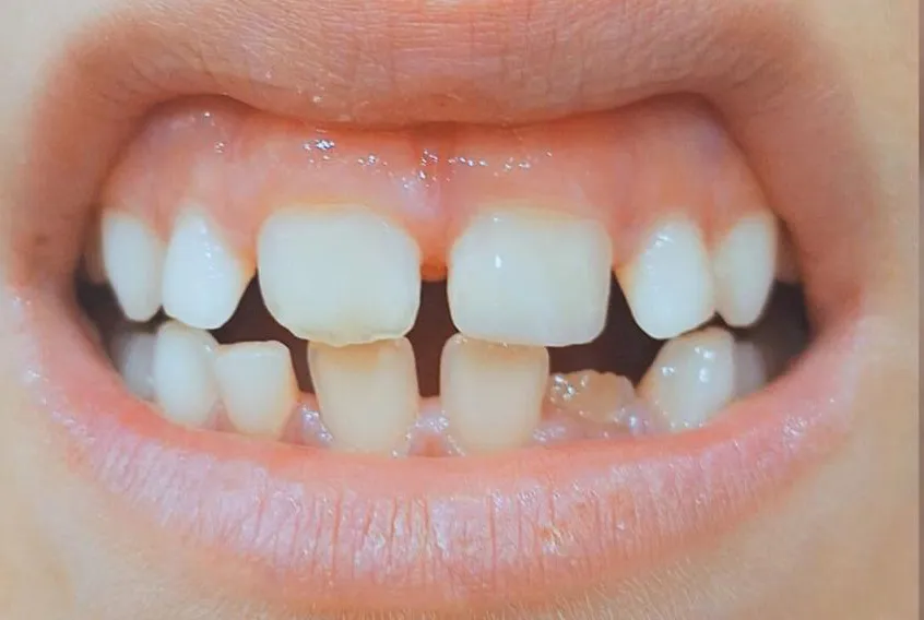 Defecto Congénito - After