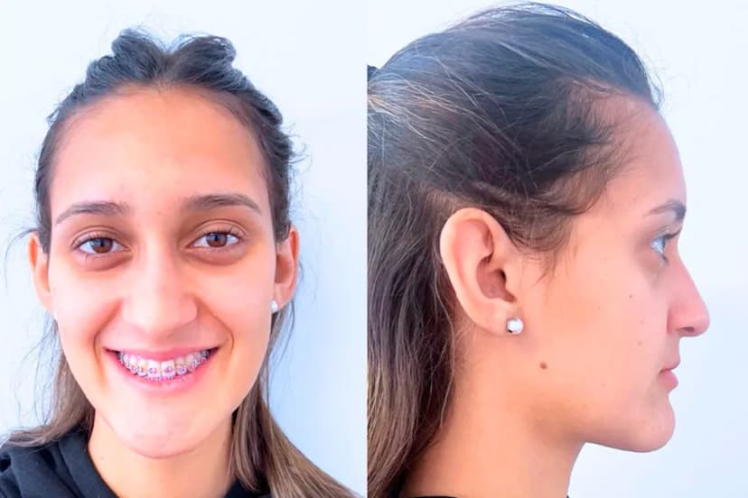 Cirugía Maxilofacial - After