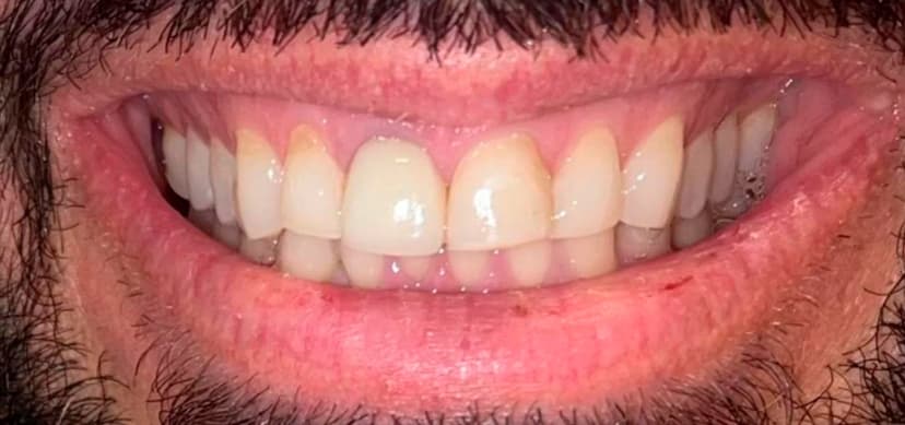 Lesiones Cervicales - Before