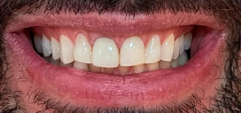 Lesiones Cervicales - After