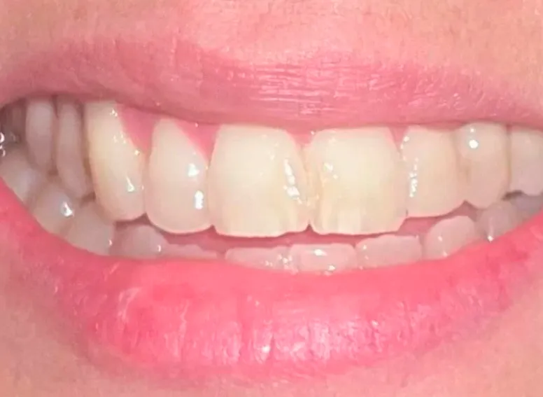 Blanqueamiento - Before