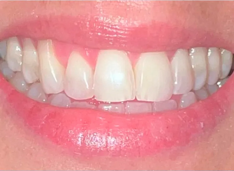 Blanqueamiento - After