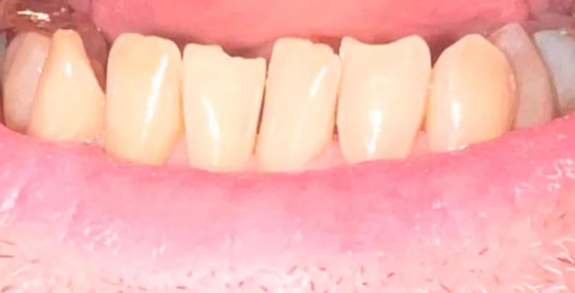 Resinas Directas - Before