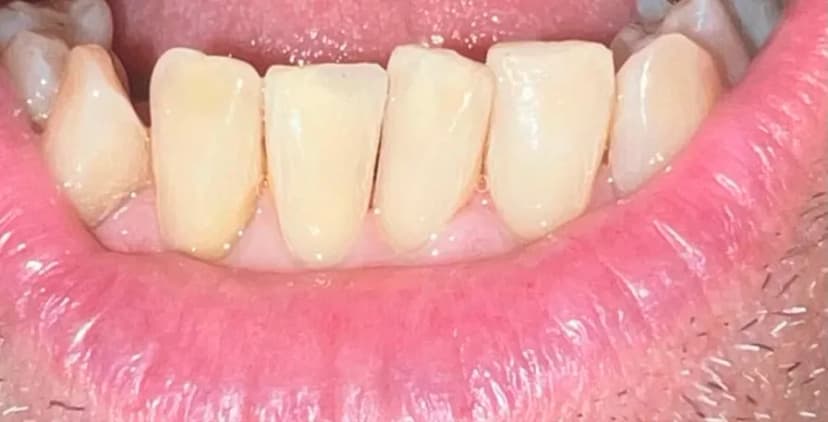 Resinas Directas - After