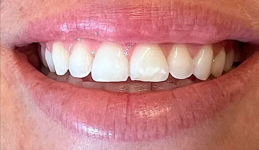 Diseño de Sonrisa - Before