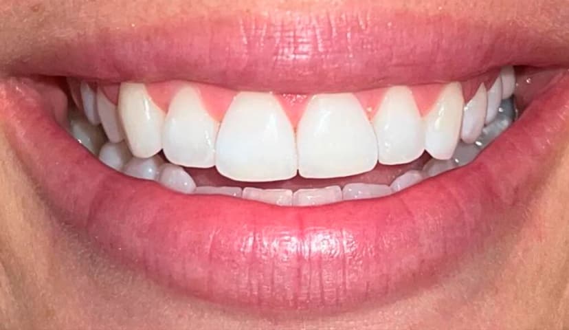 Diseño de Sonrisa - After